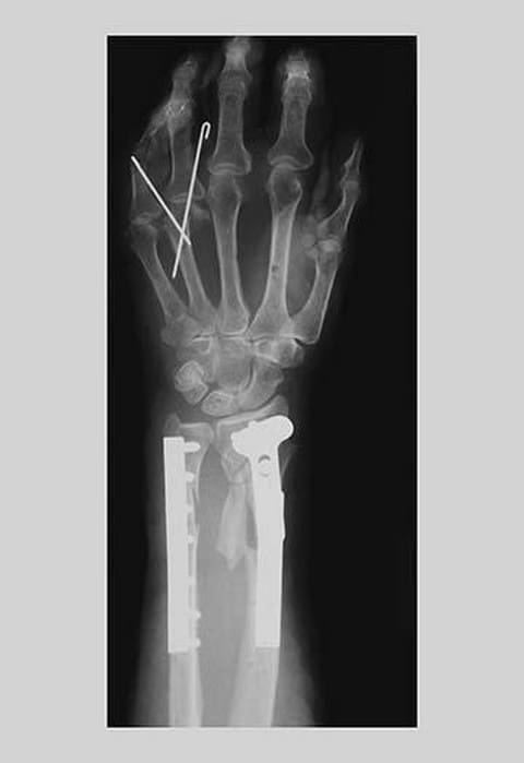 Arm and Finger Repair - Art Print