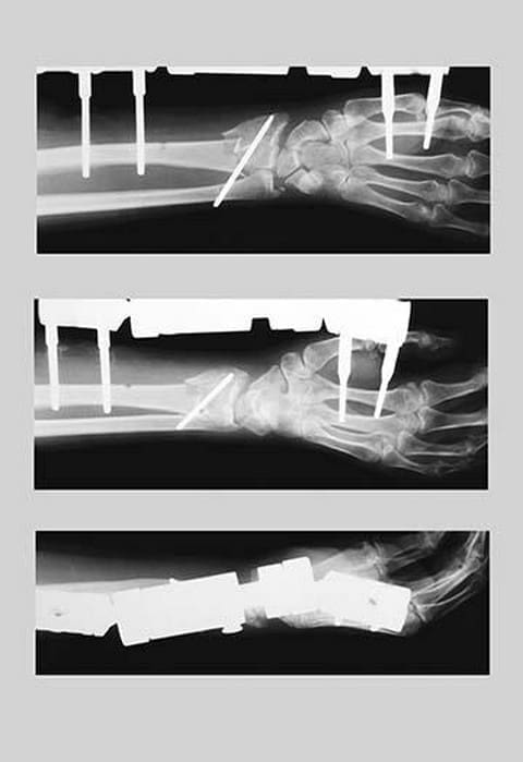 Arm with External Fixation - Art Print