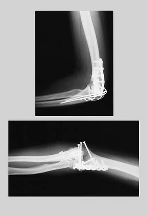 Repaired Elbow - Art Print